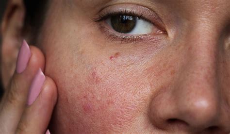 4 Facial Treatments For Rosacea That Can Help You Manage Your Symptoms