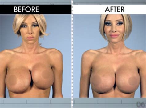pornstars with fake tits before and after breast augmentation implants page 157
