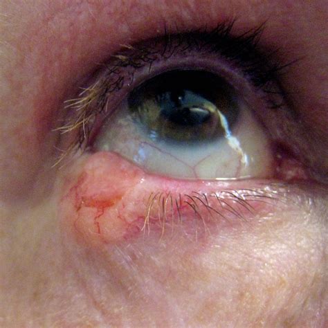 Eyelid Skin Cancers Eyelid Bcc Mr David Cheung Eyelid Specialist