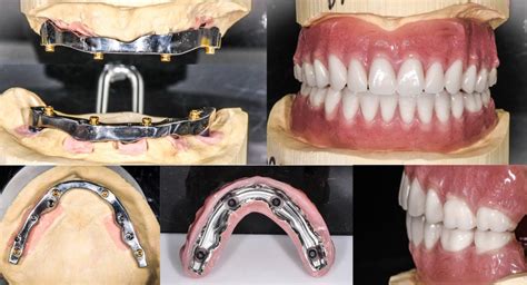 Implant Supported Overdenture Triad Dental Studio