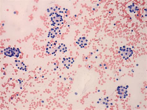 Course Cytological Differential Diagnostics Of Follicular Lesions