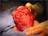 Photos of Fibroid Removal Surgery Recovery