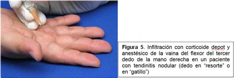 Dedo En Gatillo Síntomas Causas Y Tratamientos De Dedo En Gatillo