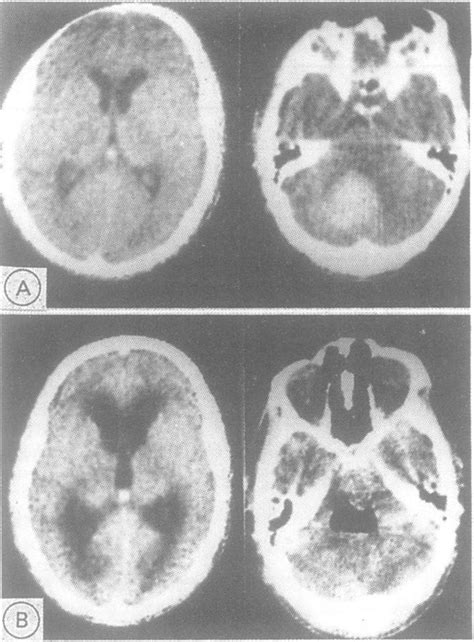 Figure A Preoperative Ct Scans Showing A Right Cerebellar Haematoma