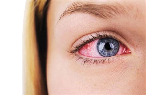 Sore Eyes Causes Symptoms And Remedies — Healthy Builderz