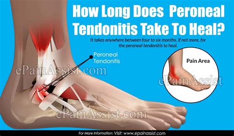 Peroneal Tendon Exercises Exercisewalls The Best Porn Website