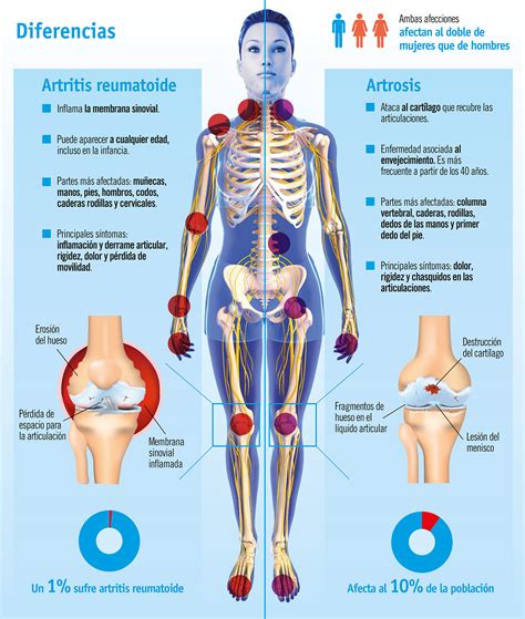 Artritis Reumatoide Qu Es Causas S Ntomas Tratamiento Y Consejos