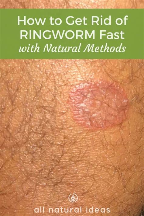 How To Get Rid Of Ringworm Fast With Natural Methods All Natural Ideas