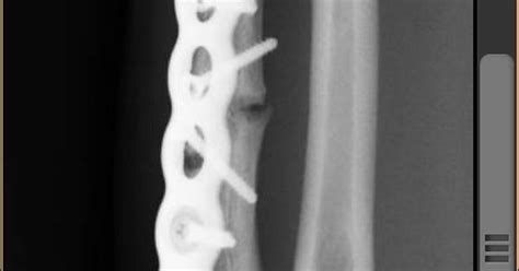 Ulna Fracture At 8 Months Imgur