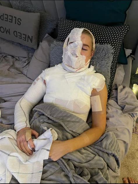 Aj Pritchards Girlfriend Abbie Quinnen Covered In Bandages After Third Degree Burns As Pals Say