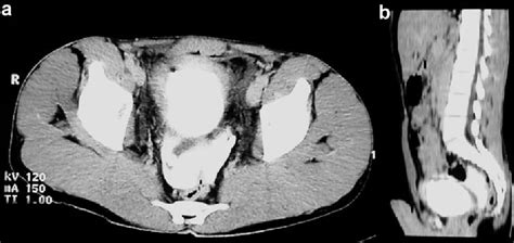 Figure 1 From Nonoperative Treatment Of Intraperitoneal Bladder Rupture