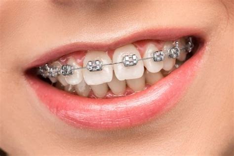 Dental Metal Ceramic Lingual Braces Invisalign Clear Aligners