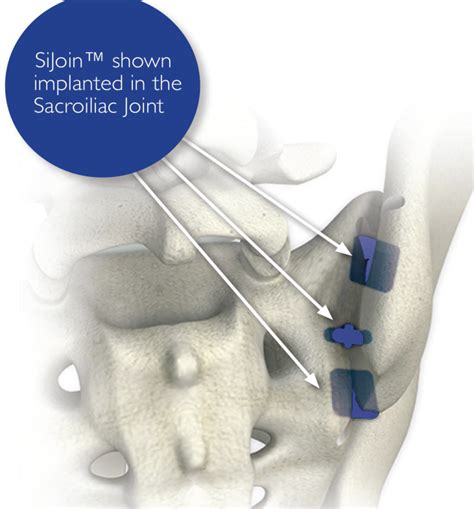 Sacroiliac Joint Si Dysfunction And Pain Treatment Procedure