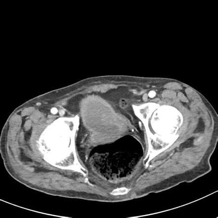 Scrotal Abscess Radiology Case Radiopaedia Org Hot Sex Picture