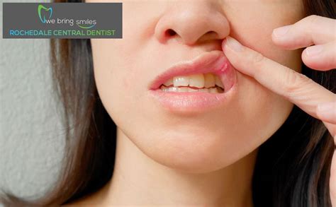 Mouth Sores Yeast Infection Causes Canker Sore Yeast Infection On Skin