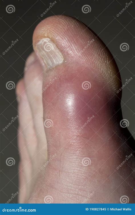 The Left Foot Big Toes With Gout Stock Image Image Of Human Body