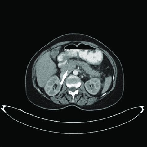 Abdominal Contrast Enhanced Computed Tomography Image Revealing