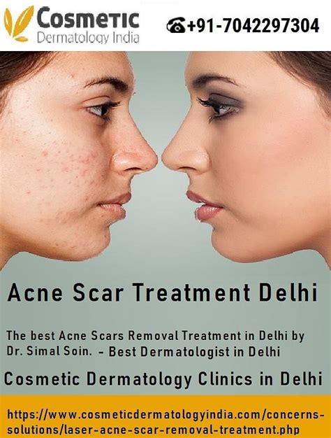 Acne Scar Treatment Delhi Photograph By Cosmetic Dermatologyindia