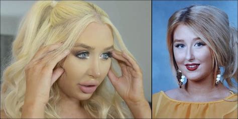 Meet The 22 Year Old Woman Whose Plastic Surgery Addiction Had Almost