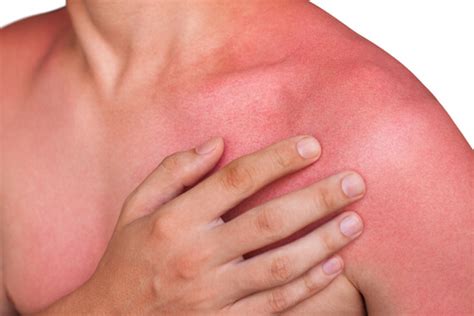 10 Distressing Sun Poisoning Symptoms