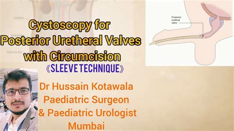 Cystoscopic Posterior Uretheral Valves Puv Fulguration With Circumcision Sleeve Method Youtube
