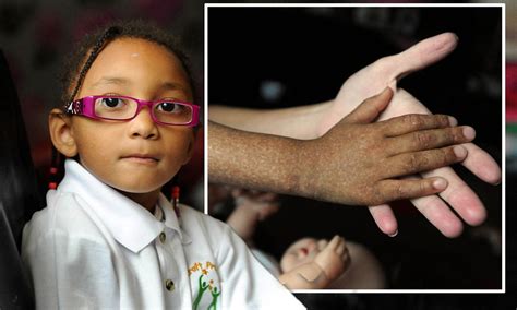 Girl With Rare Skin Condition Barred From School As No One To Supervise