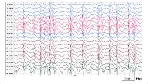 Interictal Eeg In Case 17 With Rars2 Related Disorders At The Age Of