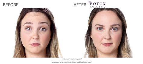 Botox In Denham Springs La Anderson Strickland Dental