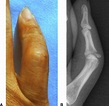 Treatment of Bony Boutonniere Deformity with a Loop Wire - Journal of ...