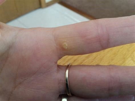 A Planters Wart On My Hand Is Almost Gone This Is A Photo Of It After