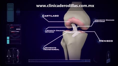 clinica de rodillas ruptura parcial ligamento cruzado anterior lca méxico youtube