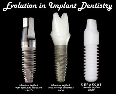 Dental Advance Clinica Estetica Odontologica Implantes dentales de zirconio La mejor opción