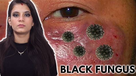 Black Fungus Symptoms And Treatment Youtube