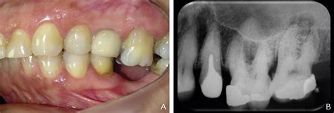 References In Intrusion Of Maxillary Molar Using Mini Implants A Clinical Report And Follow Up