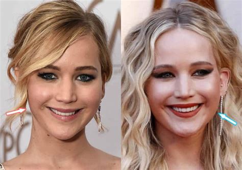 Has Jennifer Lawrence Had Plastic Surgery Before And After 2022