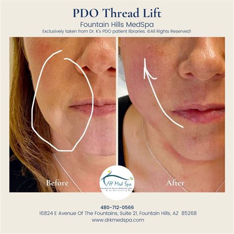 Pdo Thread Lift Before And After Dr K Med Spa Fountain Hills Arizona