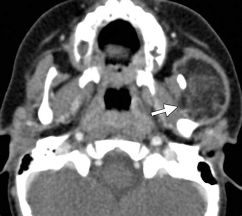 Soft Tissue Tumors Of The Head And Neck Imaging Based Review Of The