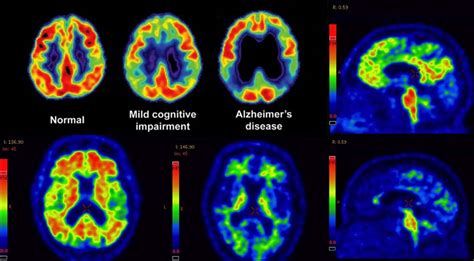 Amyloid Pet Imaging Improve Diagnosis And Alzheimers Treatment