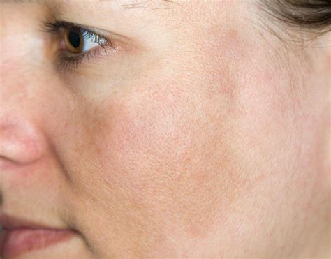 Melasma Symptoms Causes And Other Associated Risk Factors