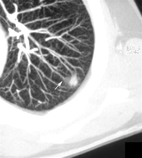 Direct Detection Of Angioinvasive Pulmonary Aspergillosis In