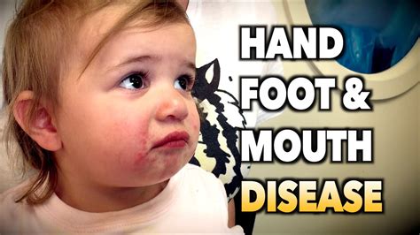 Hand Foot And Mouth Disease Live Diagnosis Dr Paul Youtube