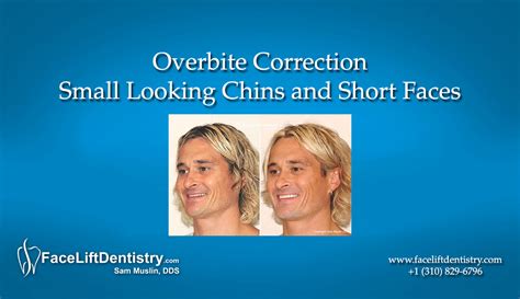 The difference between an overbite, an underbite, and a crossbite. Over Bite Correction Without Surgery or Braces