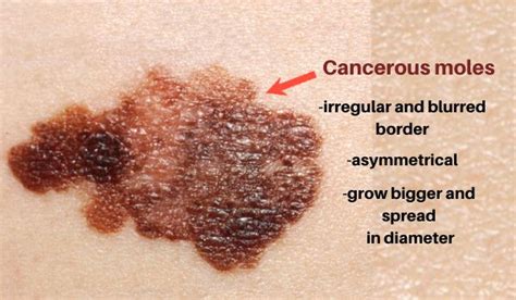Cancerous Moles How To Get Rid Of Moles On Skin