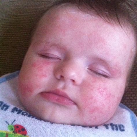Pictures Of Baby Eczema Dorothee Padraig South West Skin Health Care