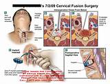 Images of 4 Level Cervical Fusion Recovery