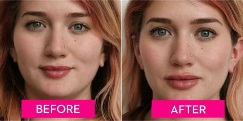 A Guide To Lip Injections From The Cost To How They Feel Before And Free Download Nude Photo