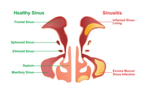 Non Allergic Rhinitis Facts Triggers Symptoms Diagnosis