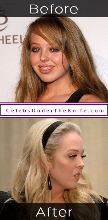 Tiffany Trump's Plastic Surgery? President's Daughter taken the plunge?
