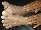Leprosy disease causes, symptoms, diagnosis, treatment and cure