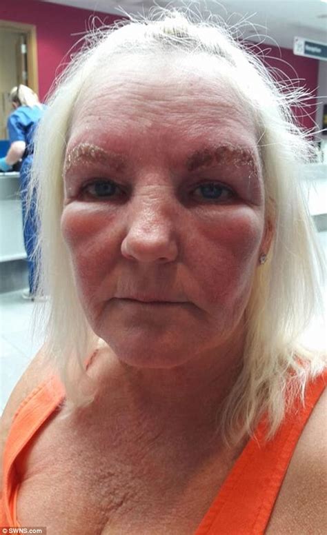 Bristol Woman Has Allergic Reaction To Eyebrow Treatment Daily Mail